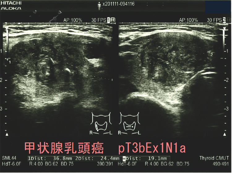 甲状腺乳頭癌 pT3bEx1N1a (矢状断) 超音波(エコー)画像 甲状腺乳頭癌 pT3bEx1N1a (矢状断) 超音波(エコー)画像
