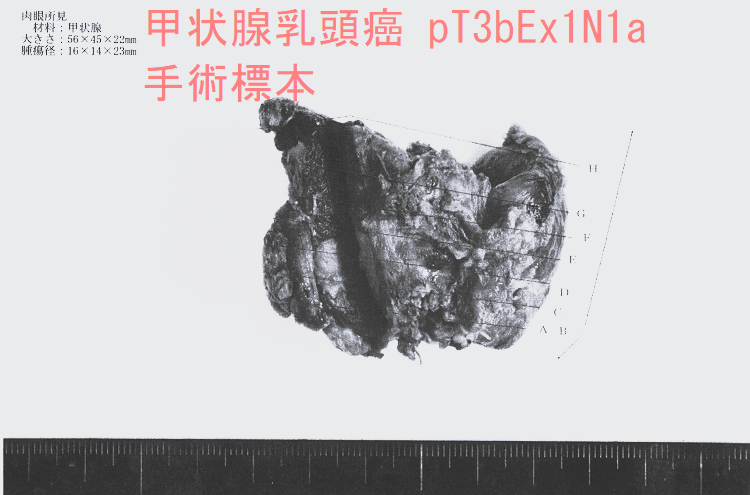 甲状腺乳頭癌 pT3bEx1N1a 手術標本 甲状腺乳頭癌 pT3bEx1N1a 手術標本2-1
