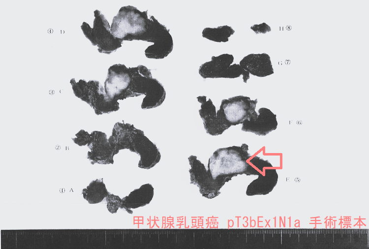 甲状腺乳頭癌 pT3bEx1N1a 手術標本 甲状腺乳頭癌 pT3bEx1N1a 手術標本
