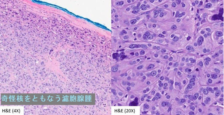 奇怪核をともなう濾胞腺腫 HE染色 奇怪核をともなう濾胞腺腫 HE染色