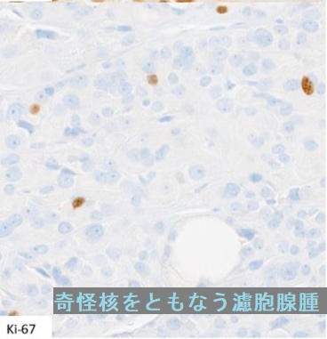 奇怪核をともなう濾胞腺腫 Ki67免疫染色 奇怪核をともなう濾胞腺腫 Ki67免疫染色