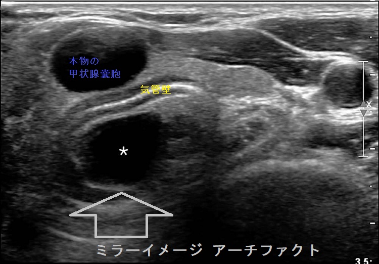 ミラーイメージ アーチファクト 超音波(エコー)画像 ミラーイメージ アーチファクト 超音波(エコー)画像