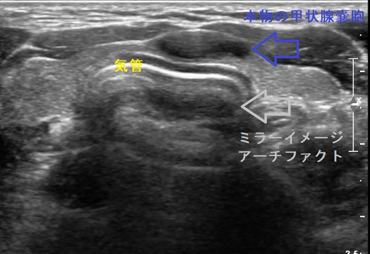 ミラーイメージ アーチファクト 超音波(エコー)画像 排液後 ミラーイメージ アーチファクト 超音波(エコー)画像 排液後