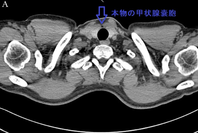 ミラーイメージ アーチファクト 頸部CT画像 ミラーイメージ アーチファクト 頸部CT画像