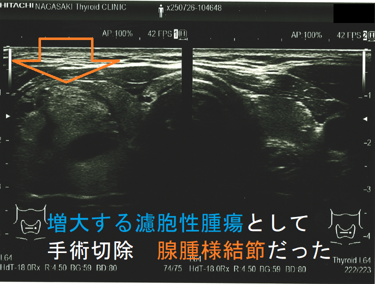 増大する濾胞性腫瘍として手術切除 腺腫様結節だった2 増大する濾胞性腫瘍として手術切除 腺腫様結節だった2