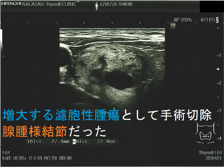 増大する濾胞性腫瘍として手術切除 腺腫様結節だった(水平断) 増大する濾胞性腫瘍として手術切除 腺腫様結節だった(水平断)