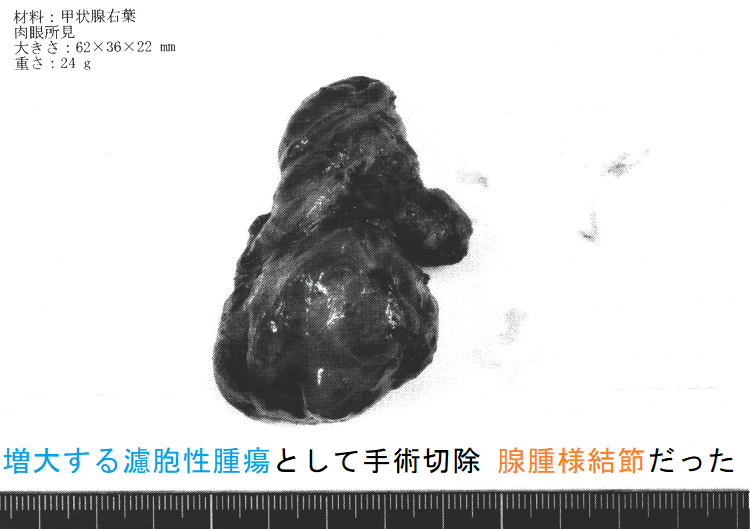 増大する濾胞性腫瘍として手術切除 腺腫様結節だった 摘出標本 増大する濾胞性腫瘍として手術切除 腺腫様結節だった 摘出標本
