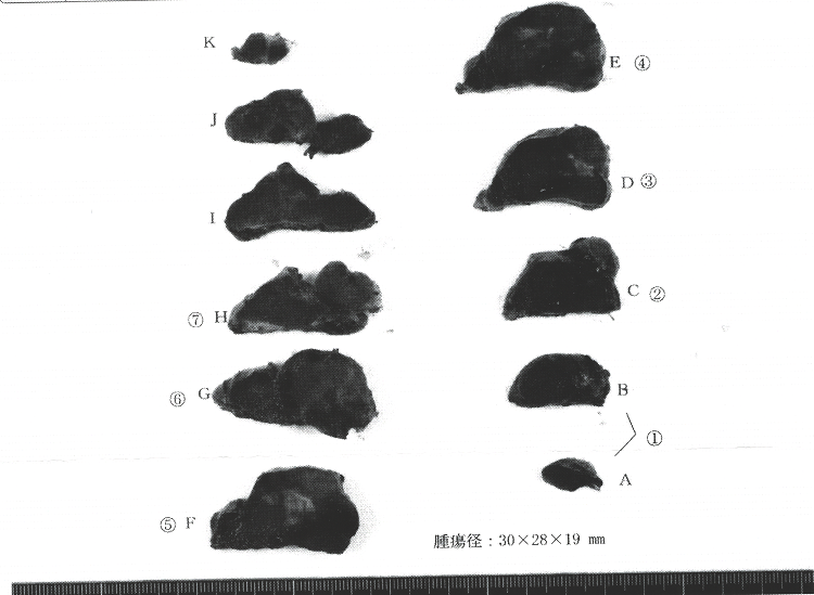 増大する濾胞性腫瘍として手術切除 腺腫様結節だった 摘出標本(割面) 増大する濾胞性腫瘍として手術切除 腺腫様結節だった 摘出標本(割面)