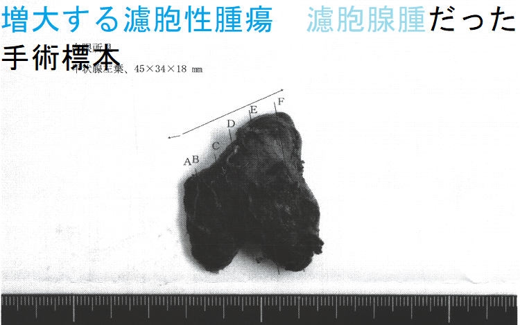 増大する濾胞性腫瘍 濾胞腺腫だった 手術標本 増大する濾胞性腫瘍 濾胞腺腫だった 手術標本