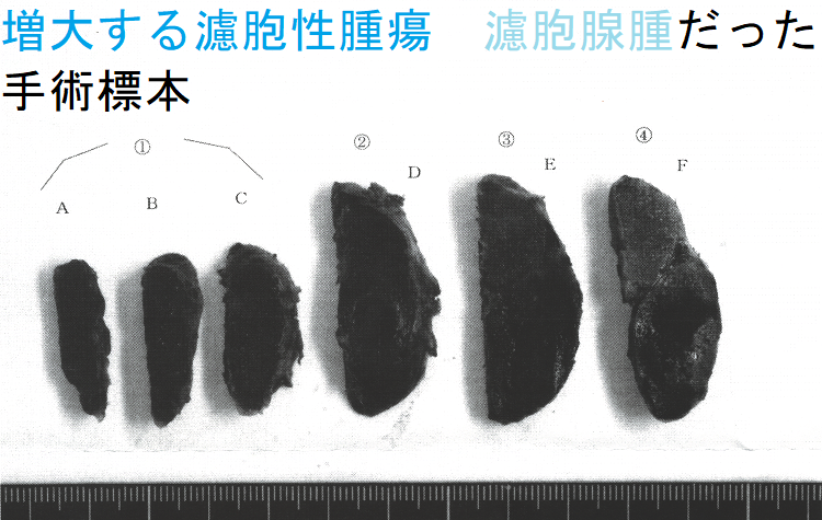 増大する濾胞性腫瘍 濾胞腺腫だった 手術標本(割面) 増大する濾胞性腫瘍 濾胞腺腫だった 手術標本(割面)