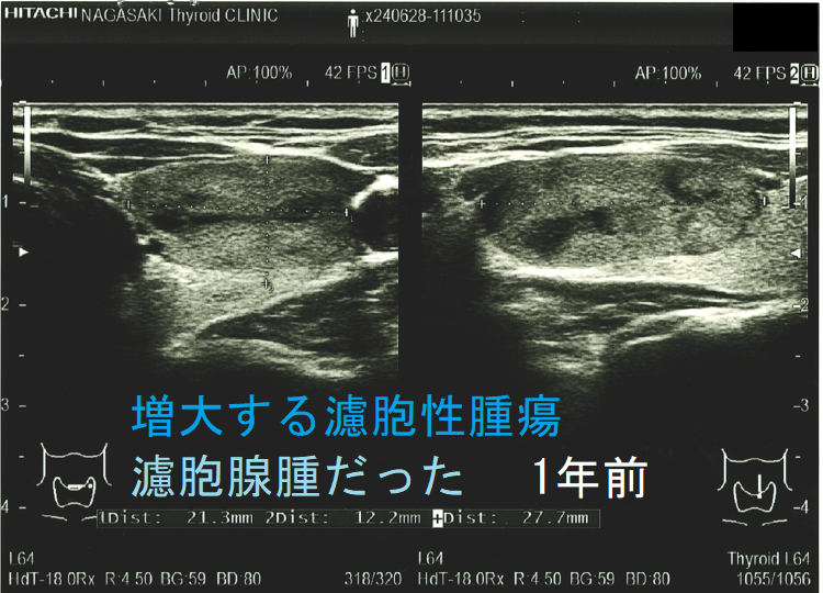 増大する濾胞性腫瘍 濾胞腺腫だった 1年前 増大する濾胞性腫瘍 濾胞腺腫だった 1年前
