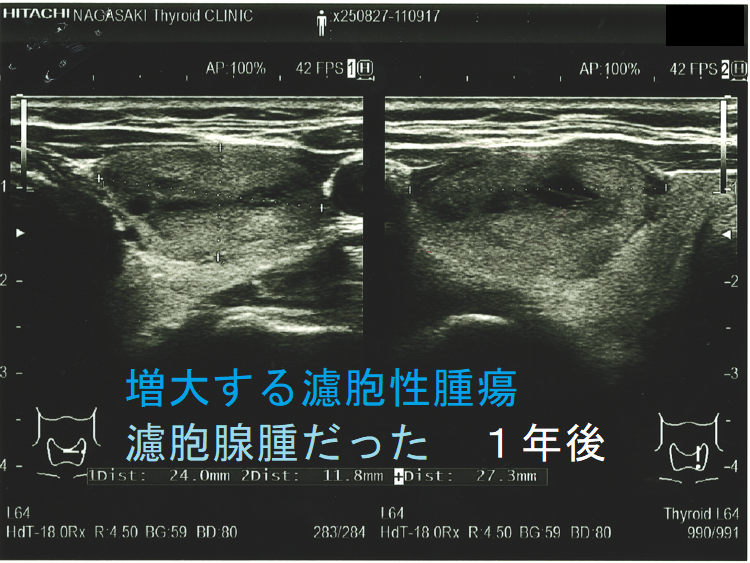 増大する濾胞性腫瘍 濾胞腺腫だった 1年後 増大する濾胞性腫瘍 濾胞腺腫だった 1年後 (2)