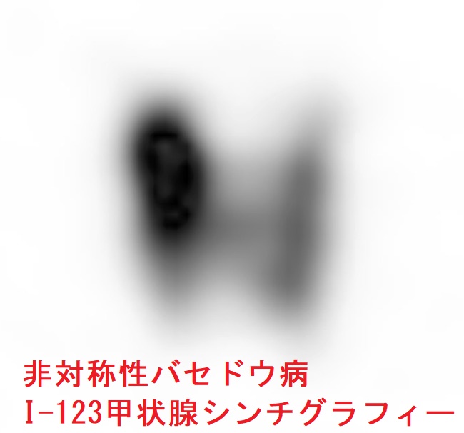 非対称性バセドウ病 I-123甲状腺シンチグラフィー 非対称性バセドウ病 I-123甲状腺シンチグラフィー