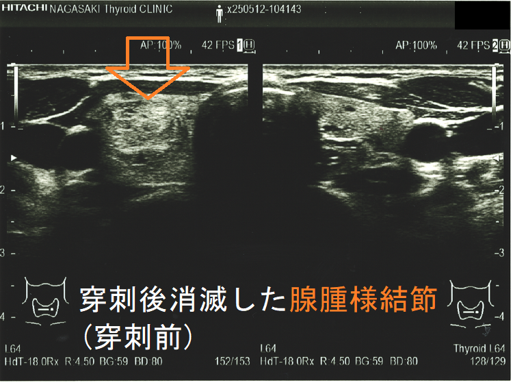 穿刺後消滅した腺腫様結節(穿刺前) 穿刺後消滅した腺腫様結節(穿刺前)