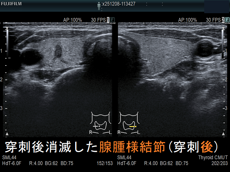 穿刺後消滅した腺腫様結節(穿刺後) 穿刺後消滅した腺腫様結節(穿刺後)