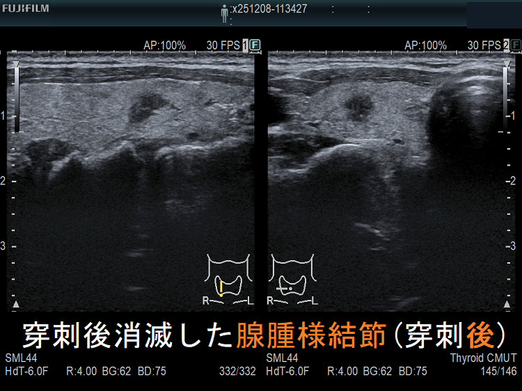 穿刺後消滅した腺腫様結節(穿刺後)2 穿刺後消滅した腺腫様結節(穿刺後)2