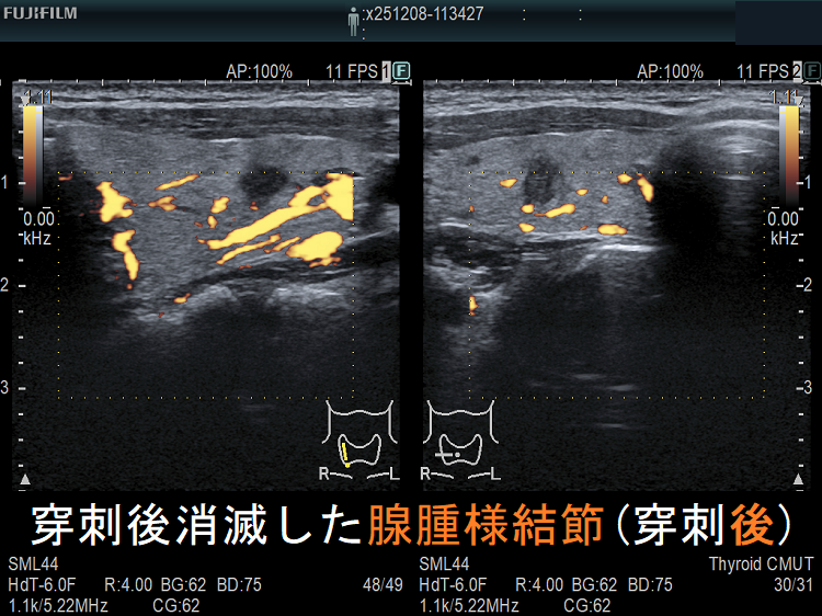 穿刺後消滅した腺腫様結節(穿刺後)ドプラーモード 穿刺後消滅した腺腫様結節(穿刺後)ドプラーモード