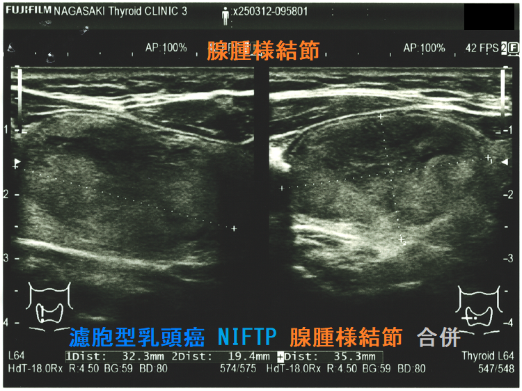 濾胞型乳頭癌 NIFTP 腺腫様結節 合併 濾胞型乳頭癌 NIFTP 腺腫様結節 合併