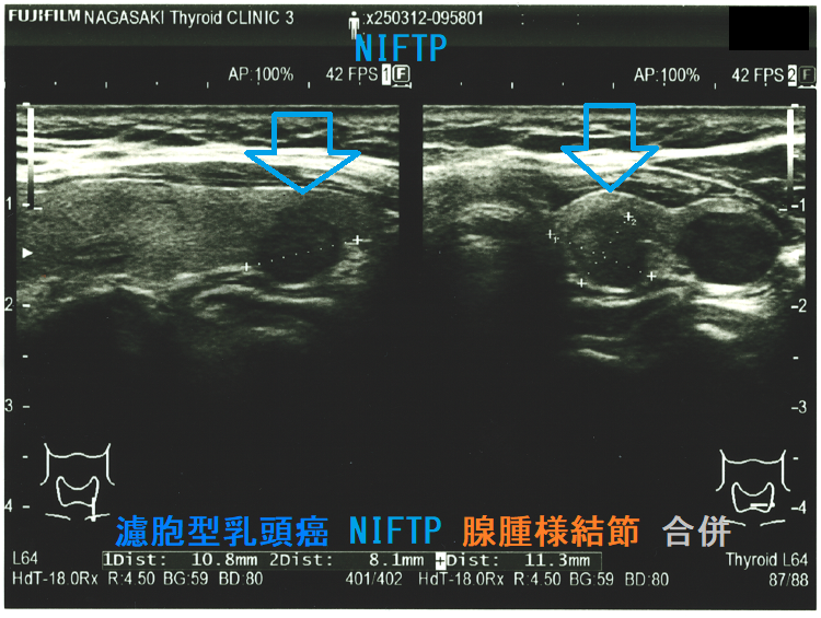 濾胞型乳頭癌 NIFTP 腺腫様結節 合併2 濾胞型乳頭癌 NIFTP 腺腫様結節 合併2