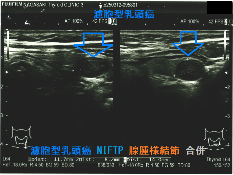 濾胞型乳頭癌 NIFTP 腺腫様結節 合併3 濾胞型乳頭癌 NIFTP 腺腫様結節 合併3