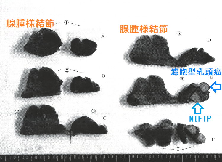 濾胞型乳頭癌 NIFTP 腺腫様結節 合併 摘出標本(割面) 濾胞型乳頭癌 NIFTP 腺腫様結節 合併 摘出標本(割面)