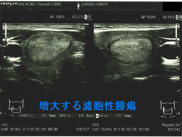 橋本病結節に見えるが甲状腺乳頭癌 増大する濾胞性腫瘍 橋本病結節に見えるが甲状腺乳頭癌 増大する濾胞性腫瘍