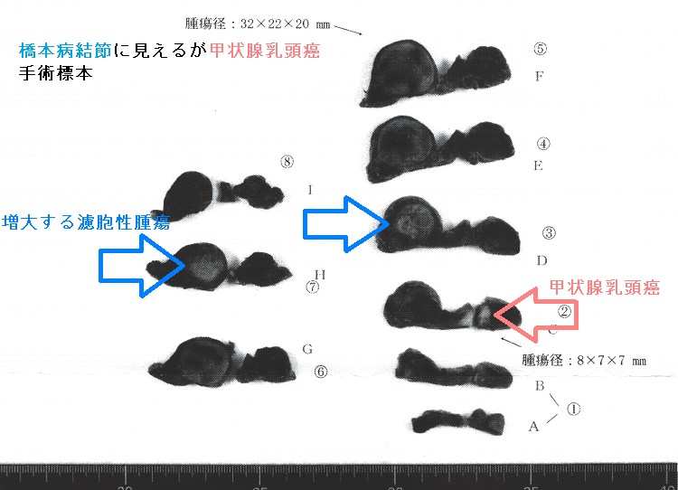 橋本病結節に見えるが甲状腺乳頭癌 手術標本 橋本病結節に見えるが甲状腺乳頭癌 手術標本