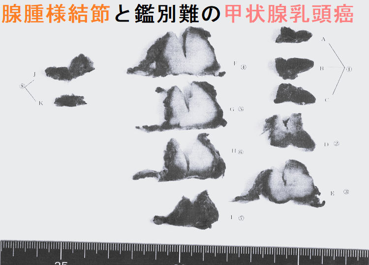 腺腫様結節と鑑別難の甲状腺乳頭癌 手術標本(割面) 腺腫様結節と鑑別難の甲状腺乳頭癌 手術標本(割面)