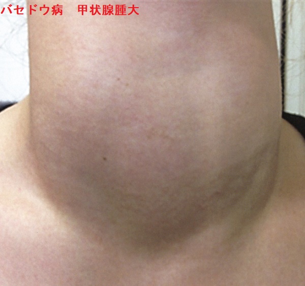 バセドウ病 甲状腺腫大(甲状腺の腫れ) バセドウ病 甲状腺腫大(甲状腺の腫れ)
