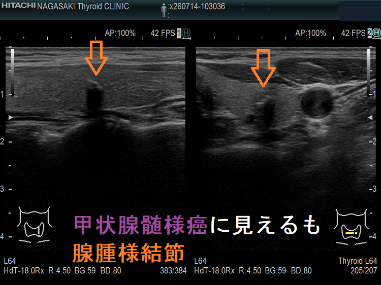 甲状腺髄様癌に見えるも腺腫様結節 甲状腺髄様癌に見えるも腺腫様結節