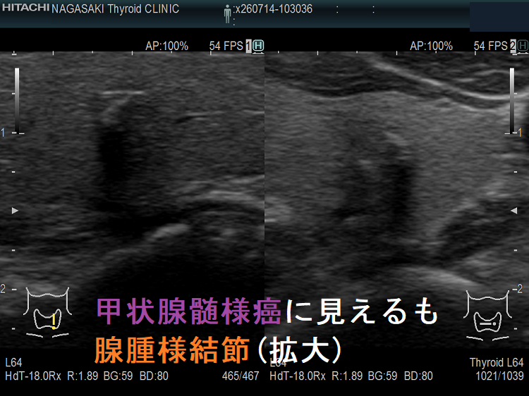 甲状腺髄様癌に見えるも腺腫様結節(拡大) 甲状腺髄様癌に見えるも腺腫様結節(拡大)