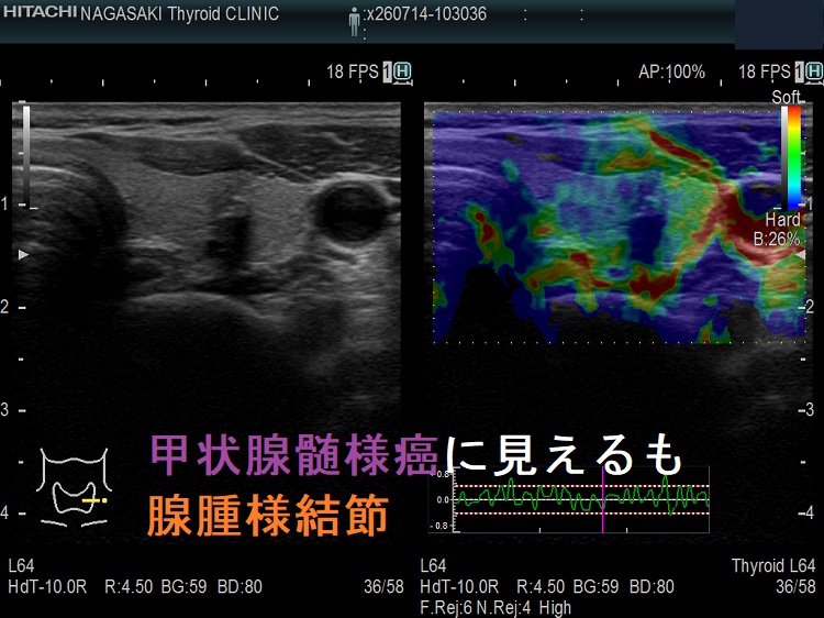 甲状腺髄様癌に見えるも腺腫様結節 エラストグラフィー 甲状腺髄様癌に見えるも腺腫様結節 エラストグラフィー