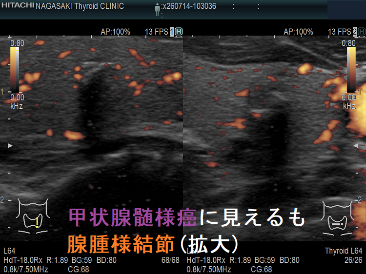 甲状腺髄様癌に見えるも腺腫様結節(拡大)ドプラーモード 甲状腺髄様癌に見えるも腺腫様結節(拡大)ドプラーモード