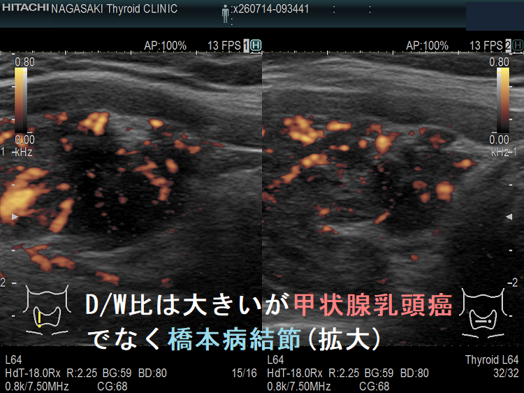 D/W比は大きいが甲状腺乳頭癌でなく橋本病結節(拡大)ドプラーモード D/W比は大きいが甲状腺乳頭癌でなく橋本病結節(拡大)ドプラーモード