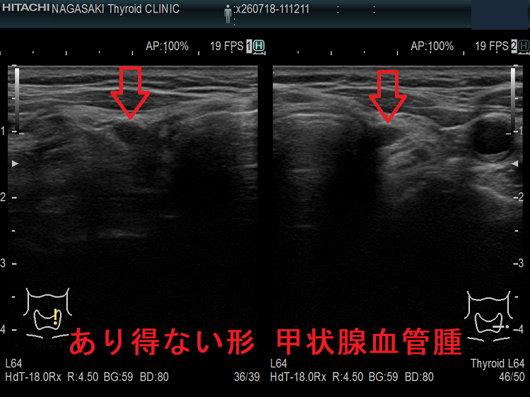 あり得ない形 甲状腺血管腫 あり得ない形 甲状腺血管腫