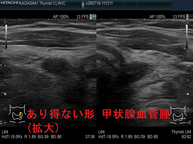 あり得ない形 甲状腺血管腫(拡大) あり得ない形 甲状腺血管腫(拡大)