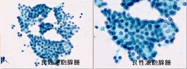 良性濾胞腺腫の細胞像