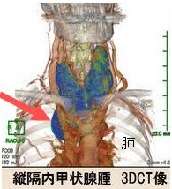 縦隔内甲状腺腫 縦隔内甲状腺腫