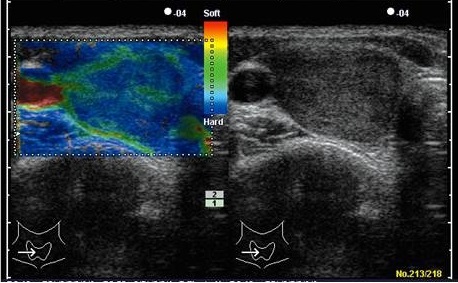 甲状腺濾胞癌　超音波(エコー)画像