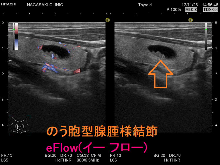 のう胞型腺腫様結節 超音波(エコー)画像 eFlow(イー フロー)