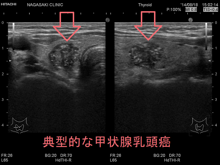 典型的な甲状腺乳頭癌 超音波（エコー）画像