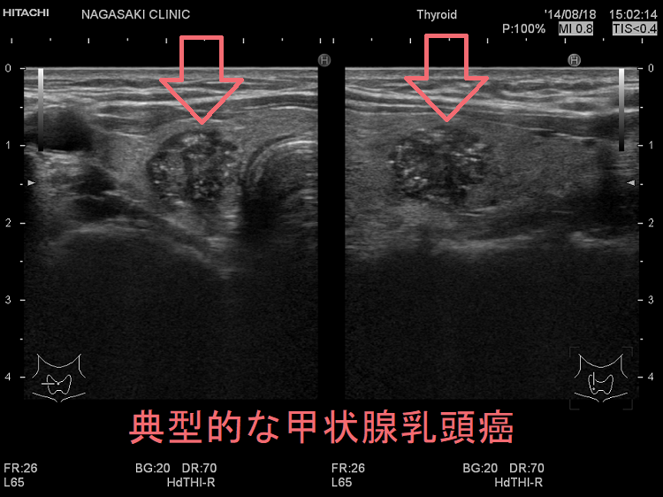 甲状腺癌/甲状腺腫瘍と遺伝性