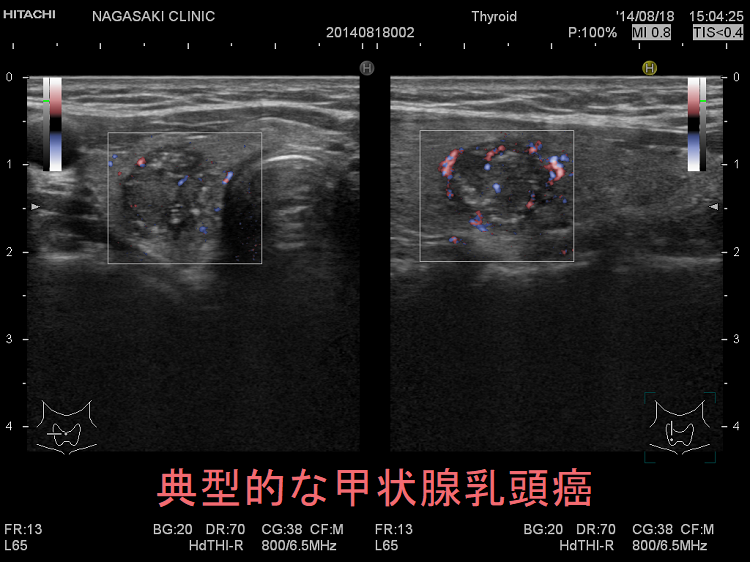 甲状腺乳頭癌の超音波（エコー）画像