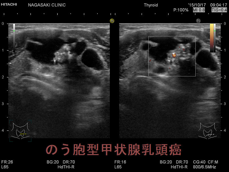 のう胞内甲状腺乳頭癌 超音波(エコー)画像