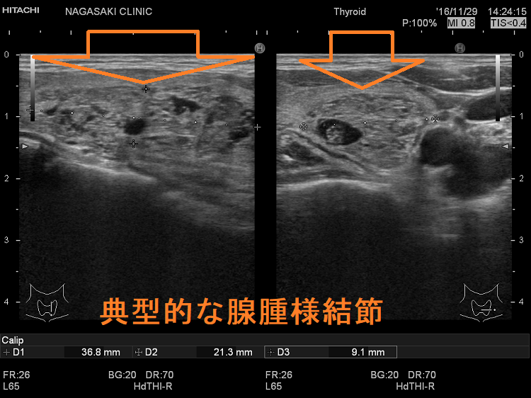 典型的な腺腫様結節 超音波(エコー)画像