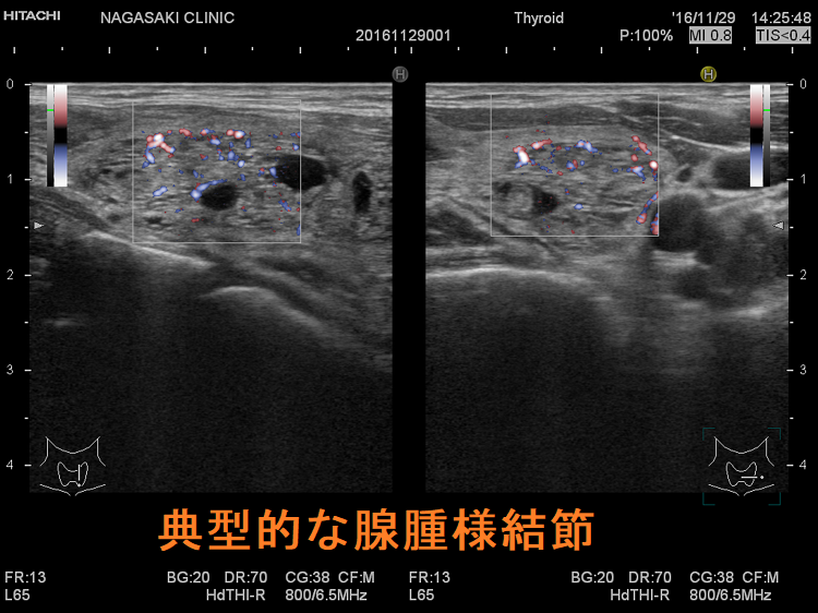 典型的な腺腫様結節 超音波(エコー)画像 ドプラー