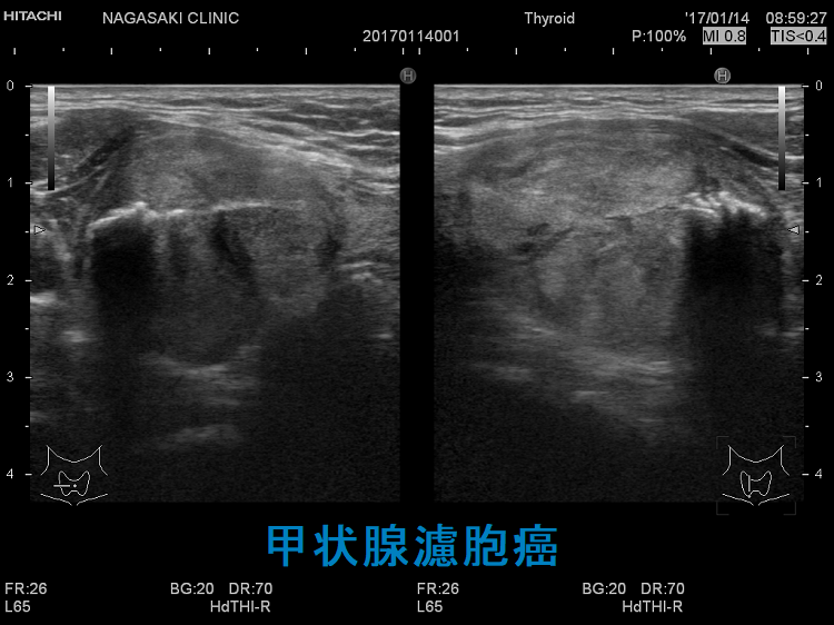 甲状腺濾胞癌 超音波（エコー）画像