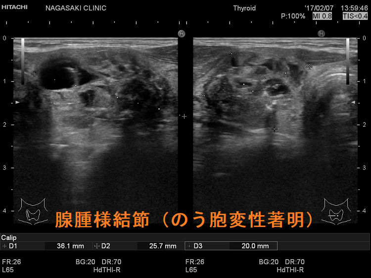 腺腫様結節（のう胞変性著明）超音波(エコー)画像