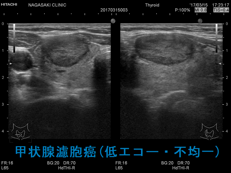 甲状腺濾胞癌（低エコー・不均一）超音波（エコー）画像