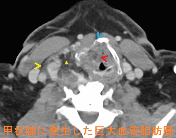甲状腺に発生した巨大血管脂肪腫 CT画像